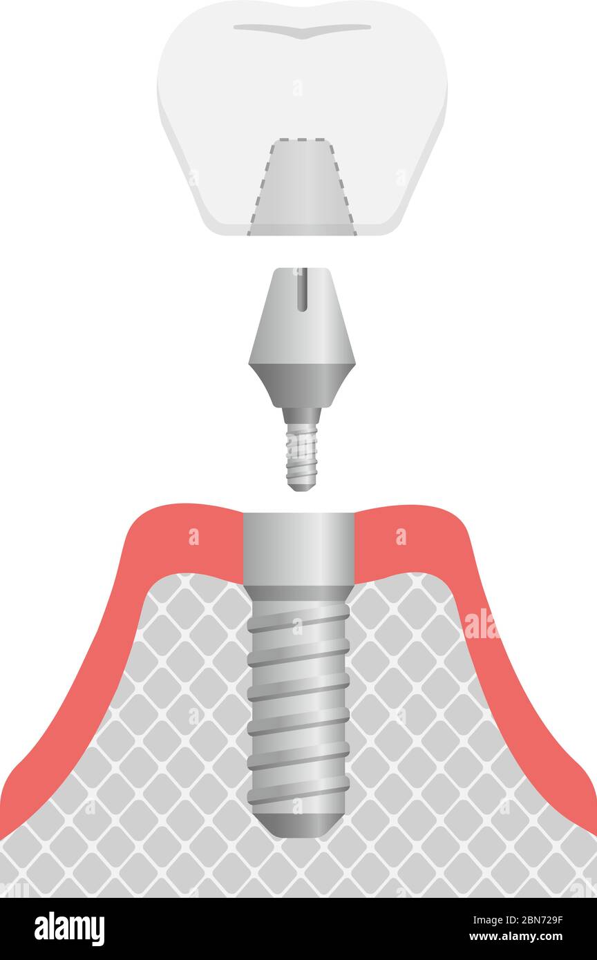 Illustration du vecteur plat de l'implant dentaire (pas de texte) Illustration de Vecteur
