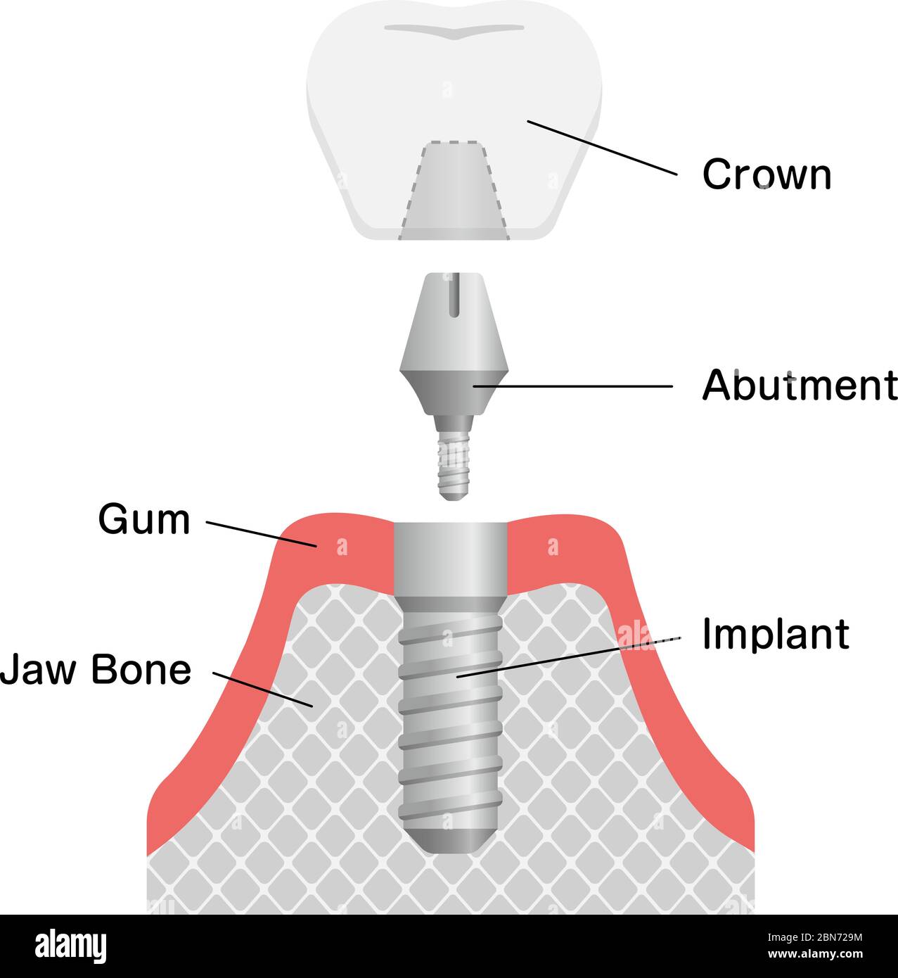 Illustration du vecteur plat de l'implant dentaire Illustration de Vecteur
