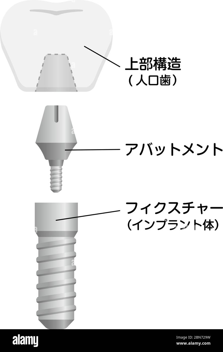 Illustration du vecteur plat de l'implant dentaire (japonais) Illustration de Vecteur