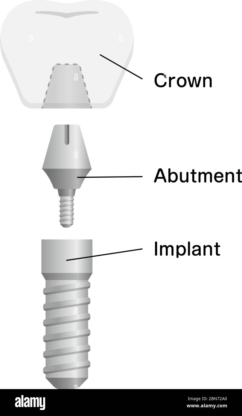Illustration du vecteur plat de l'implant dentaire Illustration de Vecteur