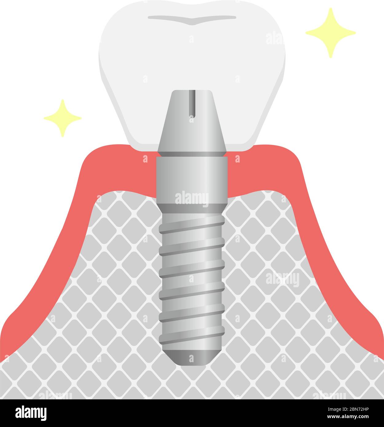 Illustration du vecteur plat de l'implant dentaire / pose de dents artificielles (couronne) Illustration de Vecteur