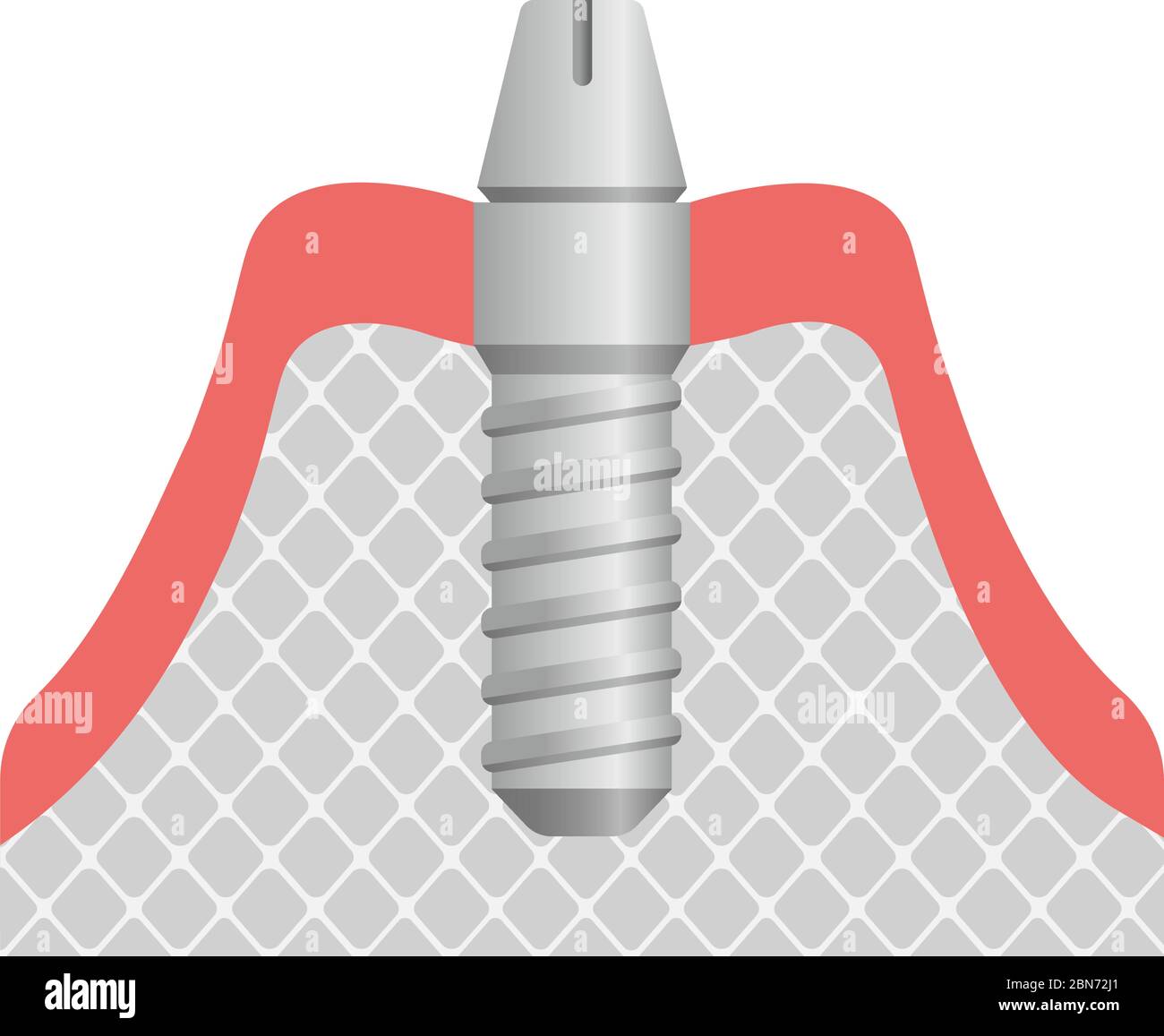 Illustration du vecteur plat de l'implant dentaire / fixation de la butée Illustration de Vecteur