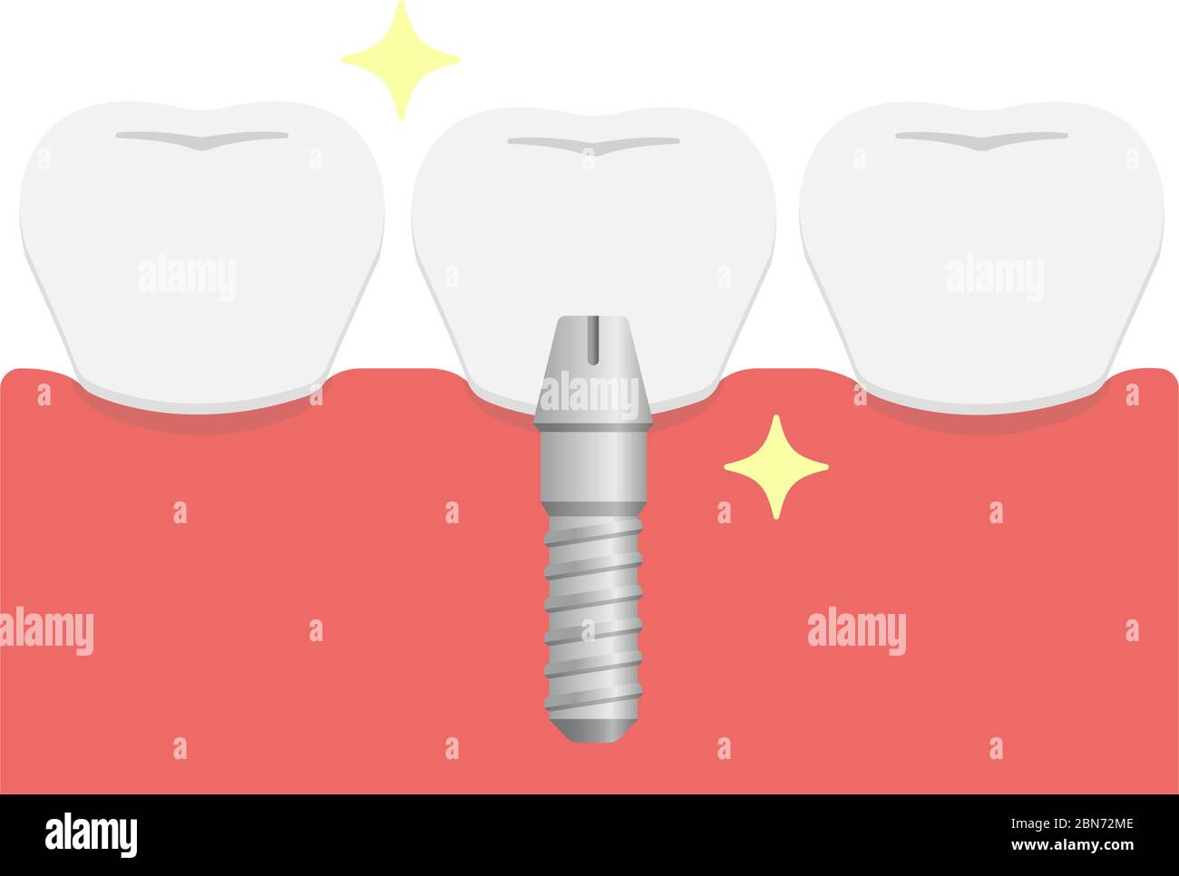 Illustration du vecteur plat de l'implant dentaire / pose de dents artificielles (couronne) Illustration de Vecteur