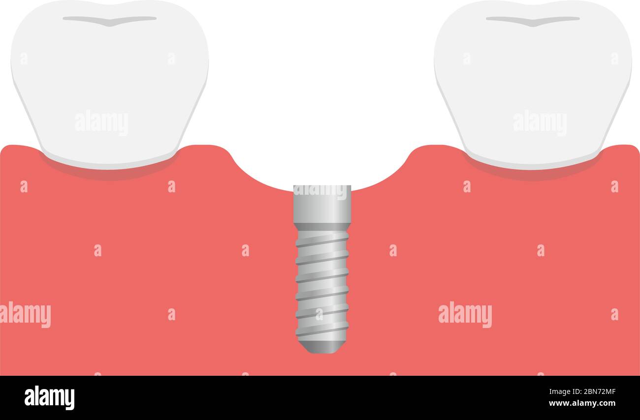 Illustration du vecteur plat de l'implant dentaire / implant dans l'os de la mâchoire Illustration de Vecteur