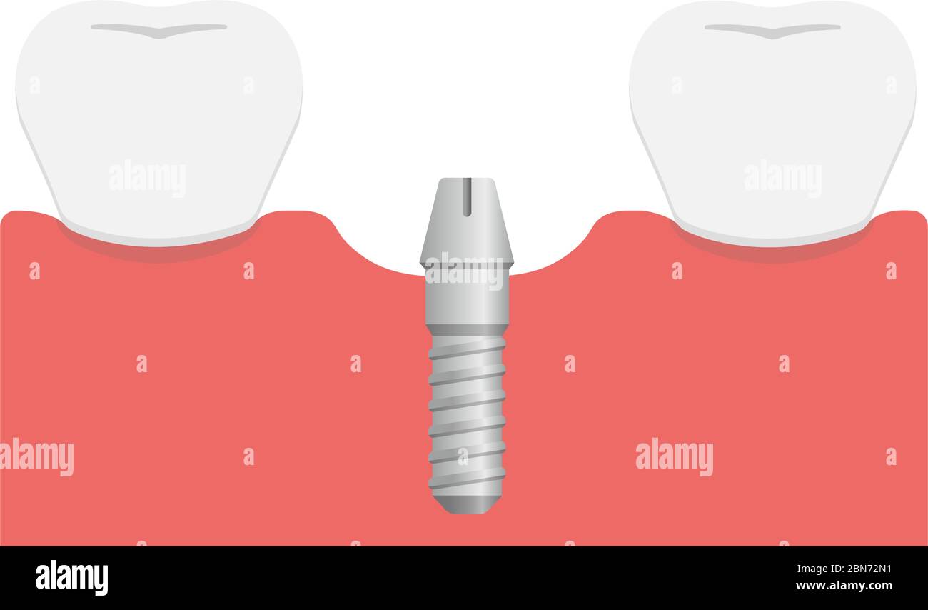 Illustration du vecteur plat de l'implant dentaire / fixation de la butée Illustration de Vecteur