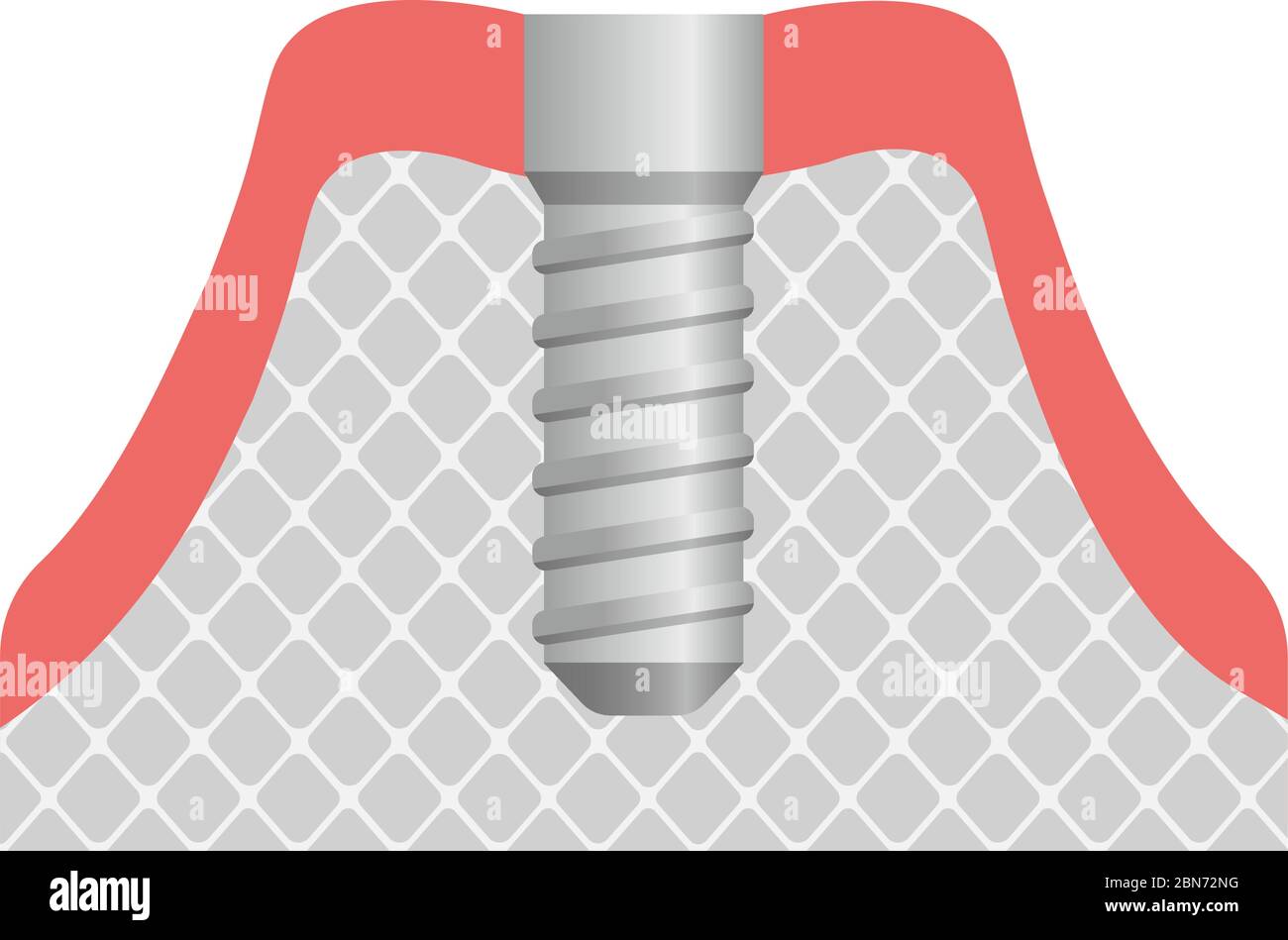 Illustration du vecteur plat de l'implant dentaire / implant dans l'os de la mâchoire Illustration de Vecteur