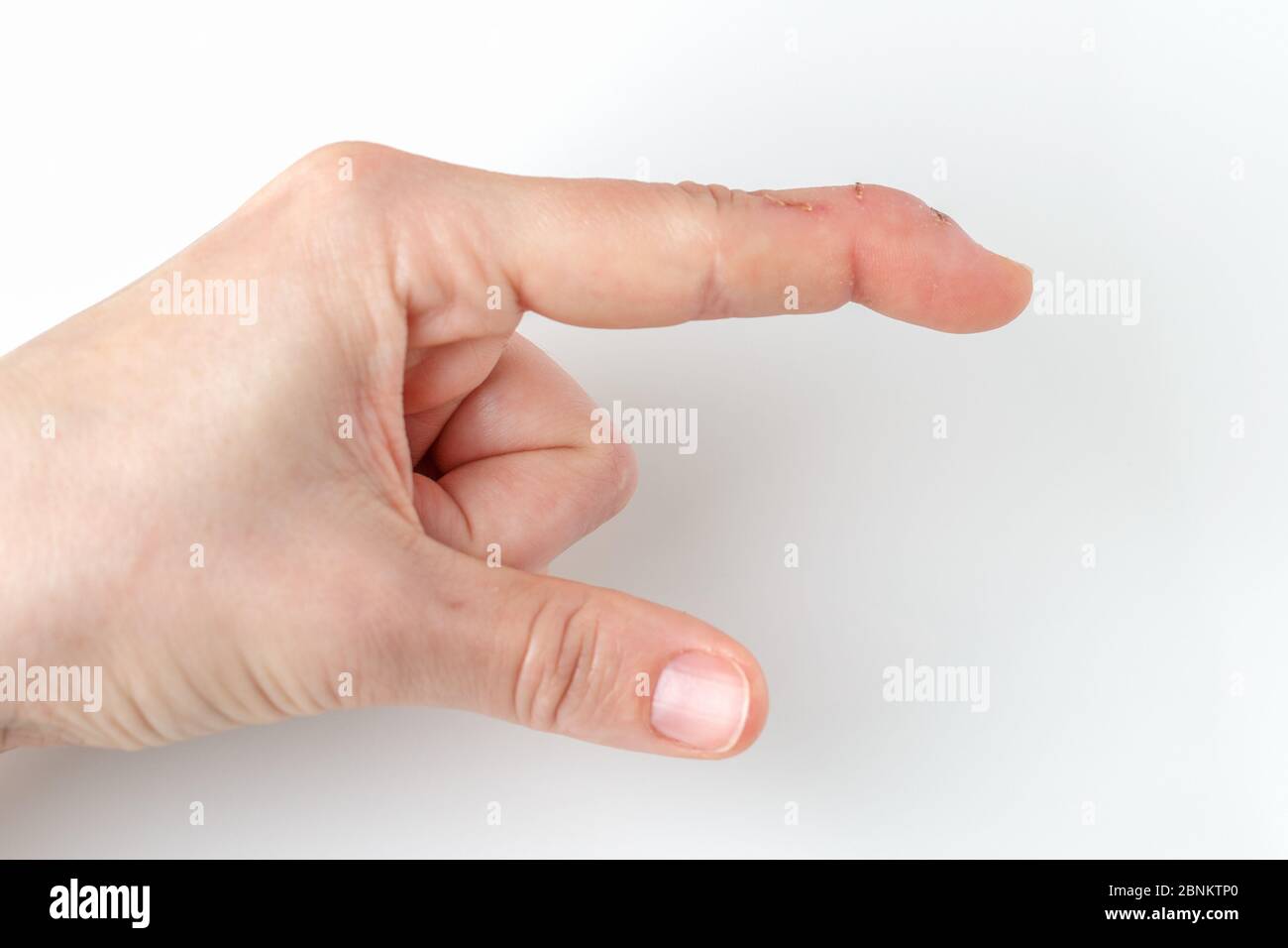 un index coupé avec une blessure au tendon extenseur, un doigt de maillet, l'extrémité du doigt se pliant vers le bas tandis que le reste du doigt reste droit, defor Banque D'Images