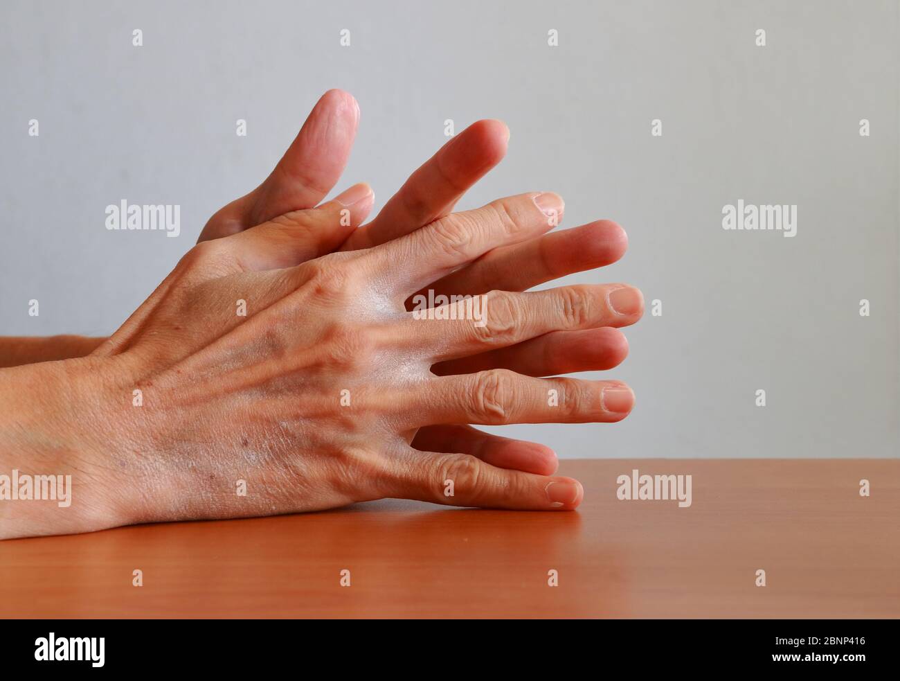 Attention sélective sur la peau reliant les doigts des mains clastées, la peau sèche causée par un trop grand lavage des mains en raison de la crainte de l'infection à coronavirus Banque D'Images