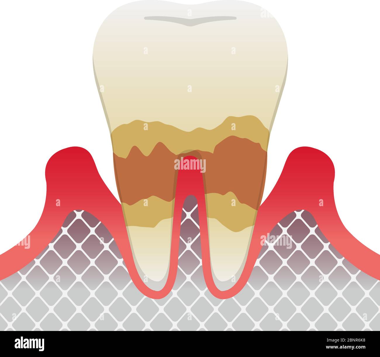 Les stades de la parodontite / parodontite modérée Illustration de Vecteur