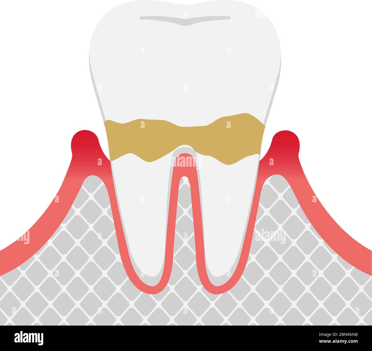 Les stades de la parodontite / parodontite légère Illustration de Vecteur