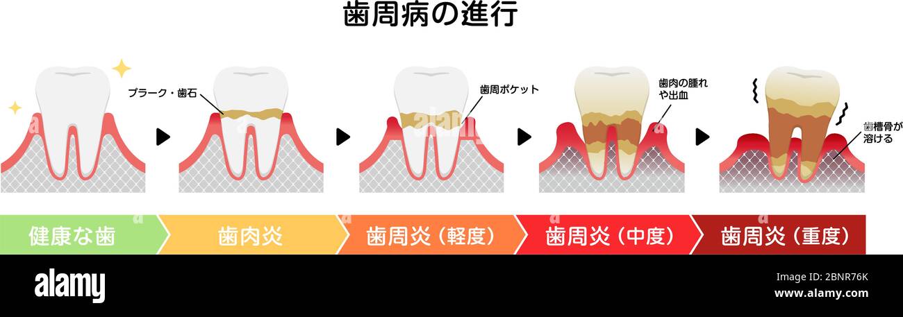 Les stades de la maladie parodontite illustration du vecteur Illustration de Vecteur