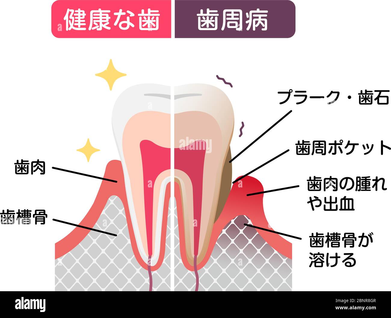Comparaison des dents normales et des maladies parodontales. illustration à vecteur plat Illustration de Vecteur