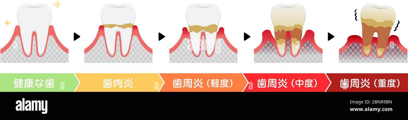 Les stades de la maladie parodontite illustration du vecteur Illustration de Vecteur