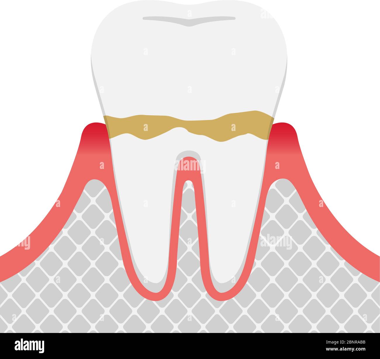Les stades de la maladie parodontite / gingivite Illustration de Vecteur