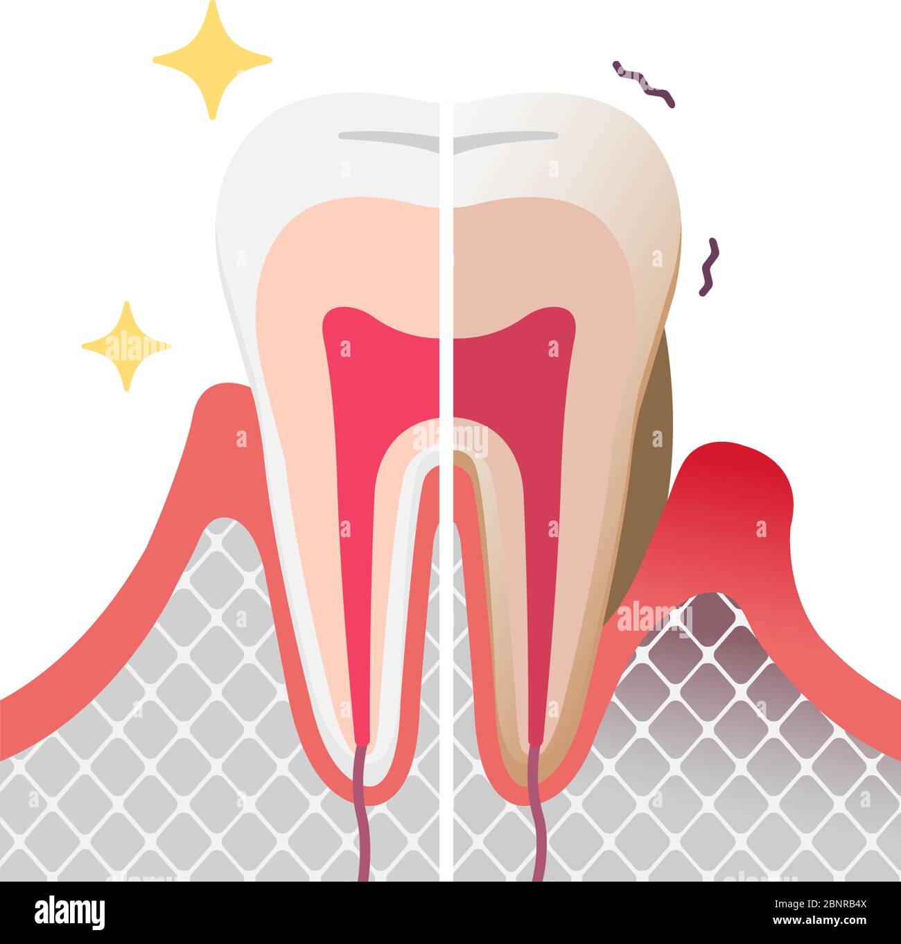 Comparaison des dents normales et des maladies parodontales. illustration à vecteur plat Illustration de Vecteur