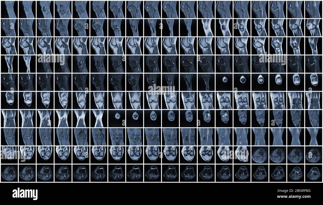 Imagerie par résonance magnétique (IRM) complète du genou gauche Banque D'Images