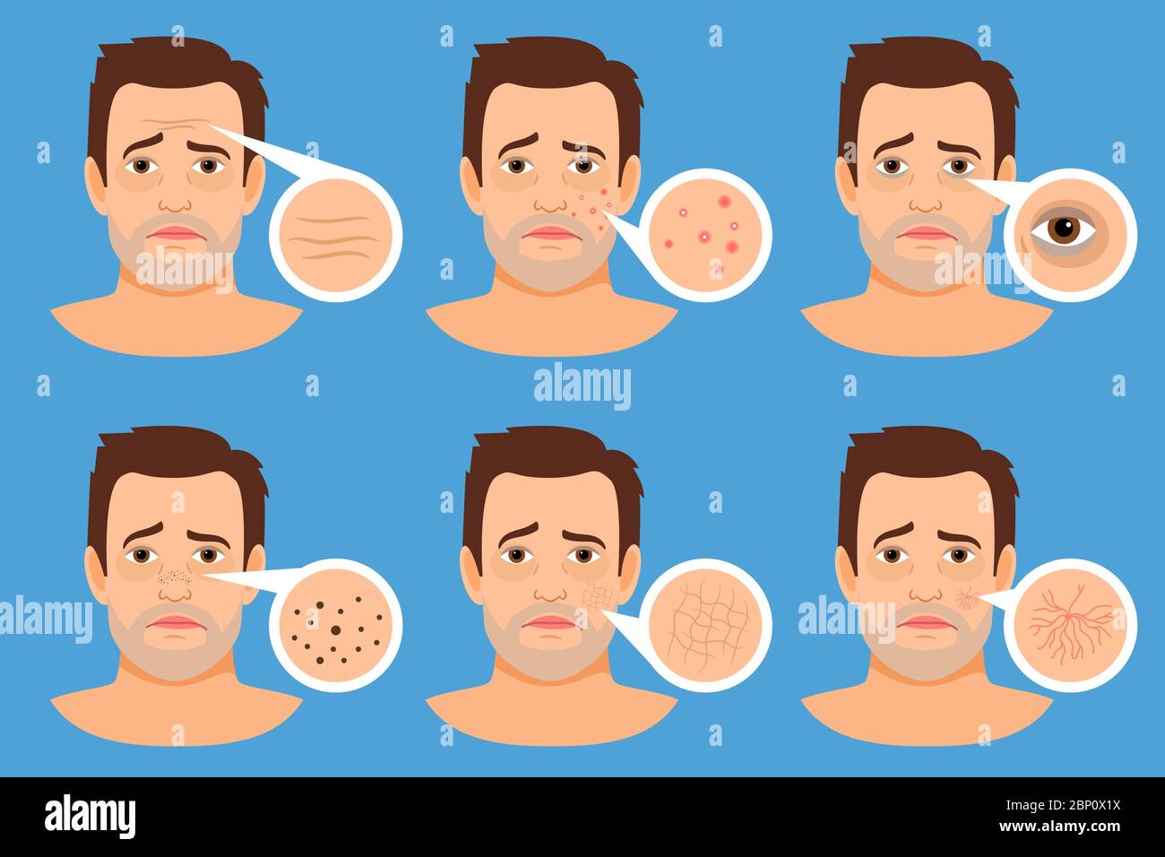 Illustration vectorielle problèmes de peau d'homme. Visage masculin avec des boutons et des taches sombres, des rides et de l'acné Illustration de Vecteur
