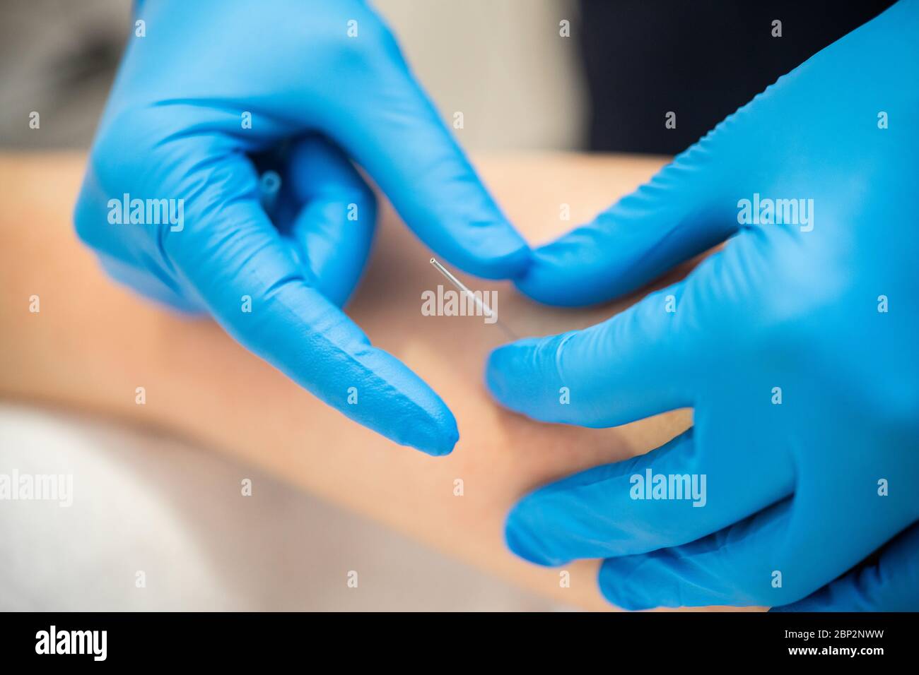 Mains de physiothérapeute faisant un aiguillage sec Banque D'Images