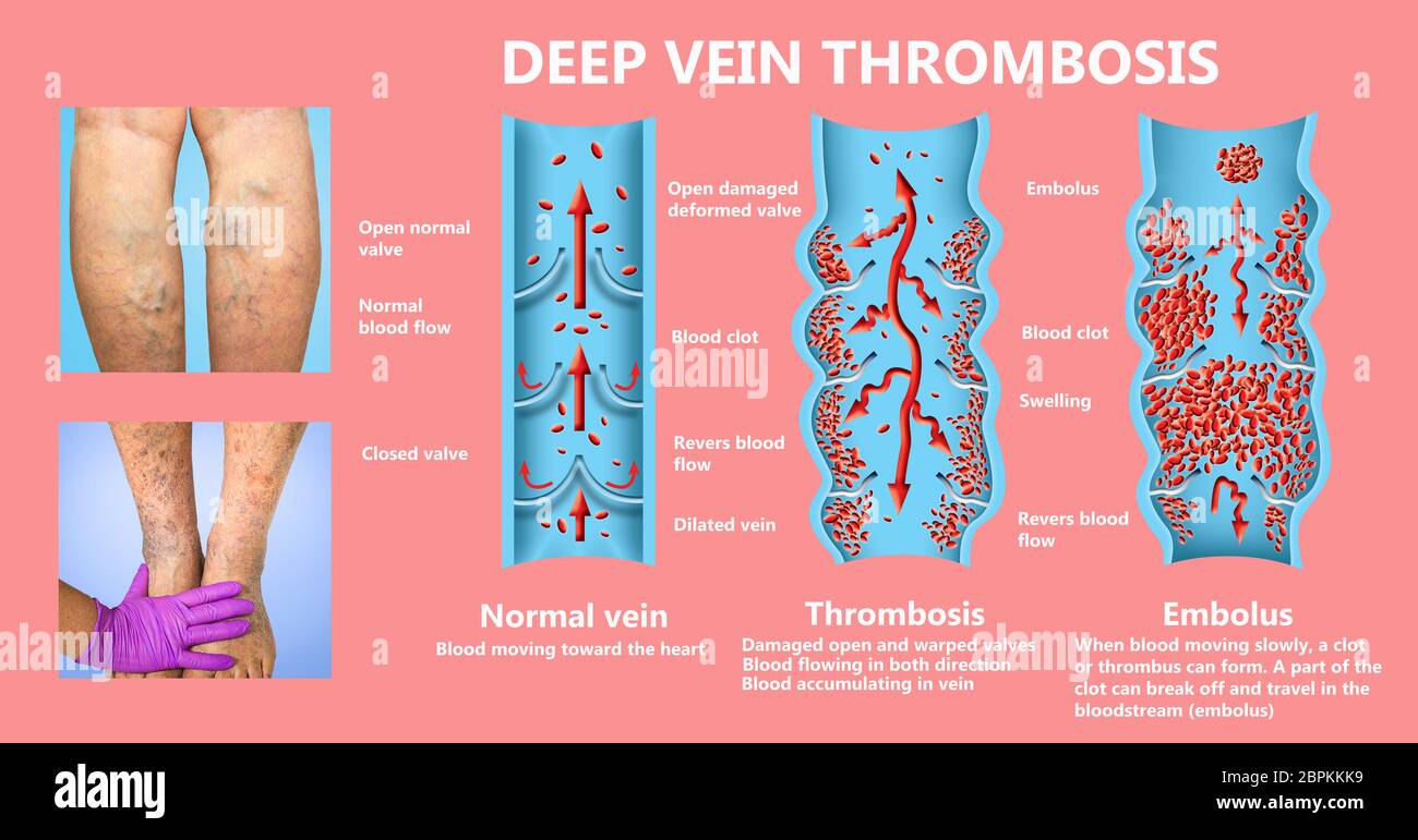 Thrombose veineuse profonde ou des caillots de sang. Embolie gazeuse. Structure de la normale et les varices veines femelle Banque D'Images
