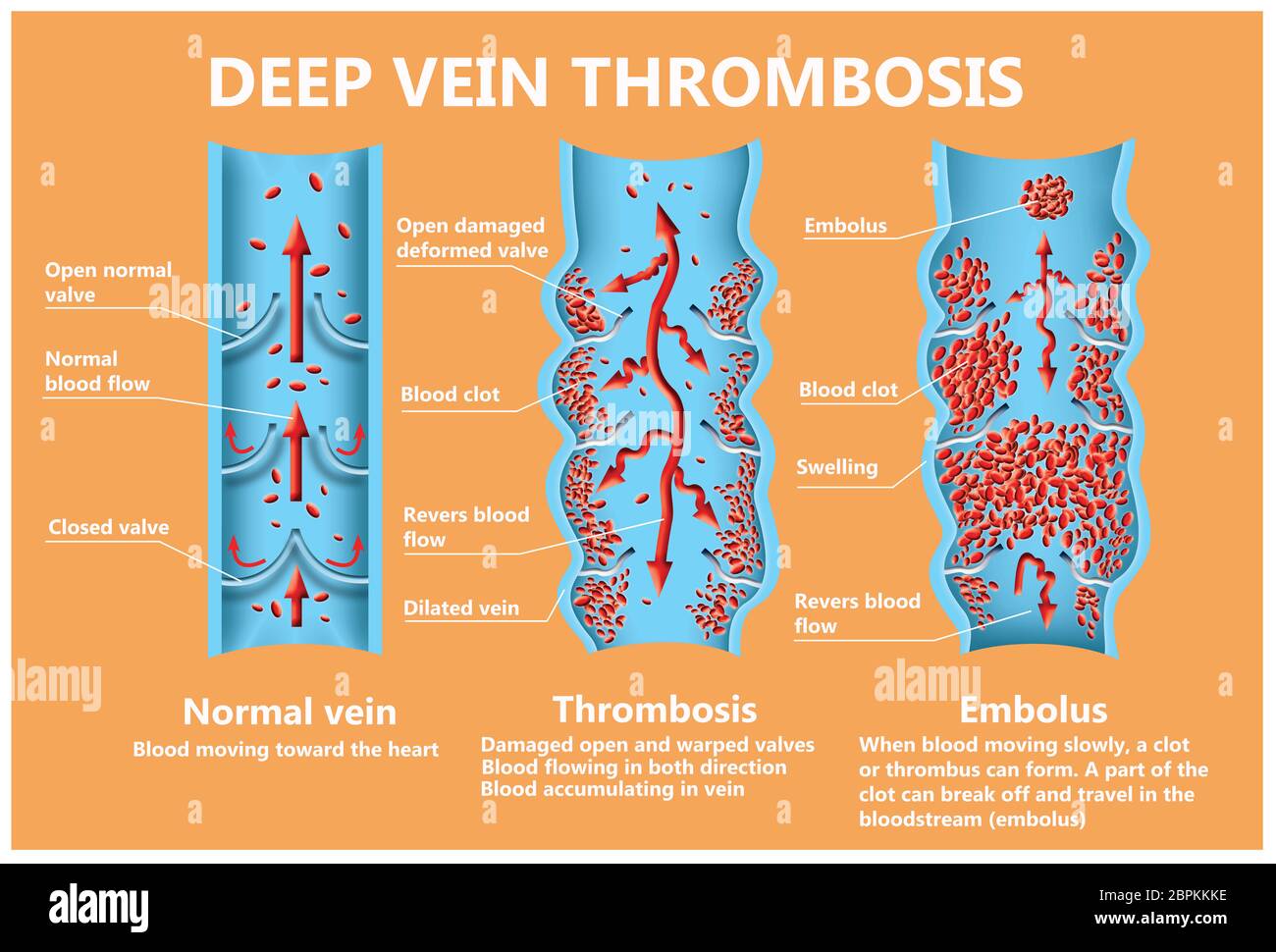 La thrombose. De la normale de la circulation sanguine vers la formation de caillots sanguins et clot, qui voyage dans le sang. L'embolie. Illustration pour la biologie, le medi Banque D'Images