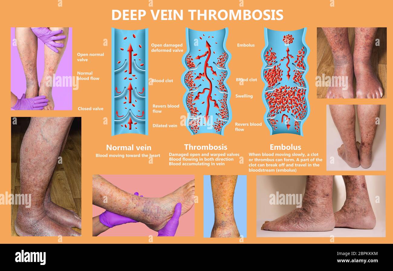 La thrombose. De la normale de la circulation sanguine vers la formation de caillots sanguins et clot, qui voyage dans le sang. L'embolie. Illustration pour la biologie, le medi Banque D'Images