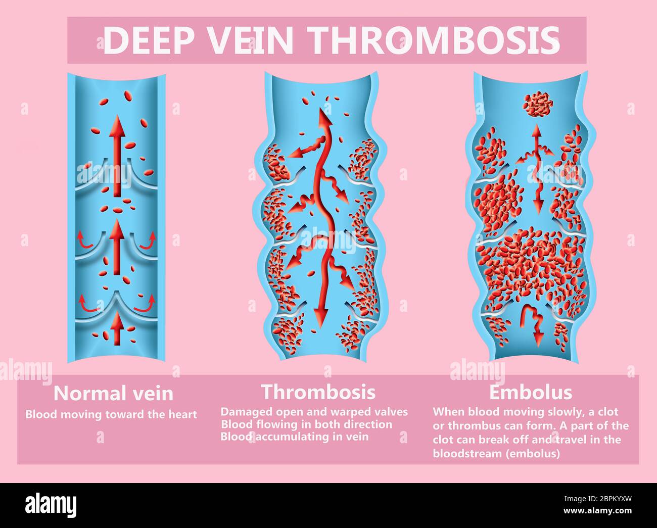 La thrombose. De la normale de la circulation sanguine vers la formation de caillots sanguins et clot, qui voyage dans le sang. L'embolie. Illustration pour la biologie, le medi Banque D'Images