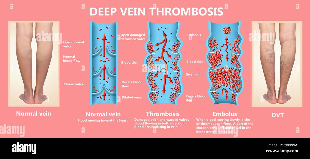 Thrombose veineuse profonde ou des caillots de sang. Embolie gazeuse. Structure de la normale et les varices veines femelle Banque D'Images