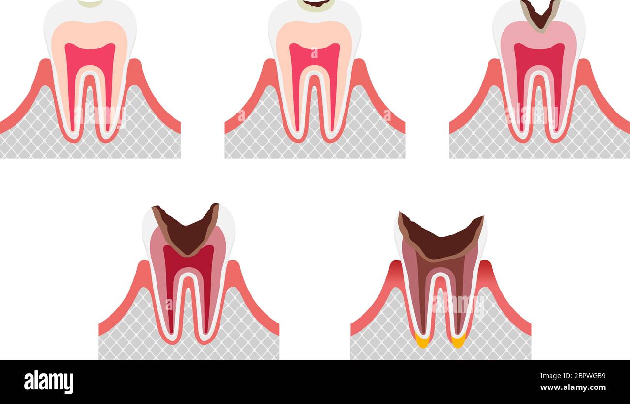 Les étapes de la carie dentaire / l'ensemble d'illustrations à vecteur plat Illustration de Vecteur