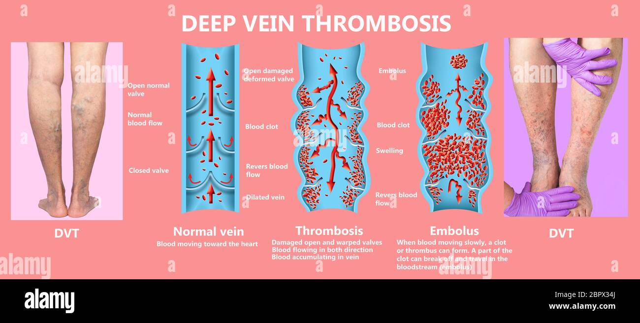 Thrombose veineuse profonde ou des caillots de sang. Embolie gazeuse. Structure de la normale et les varices veines femelle Banque D'Images
