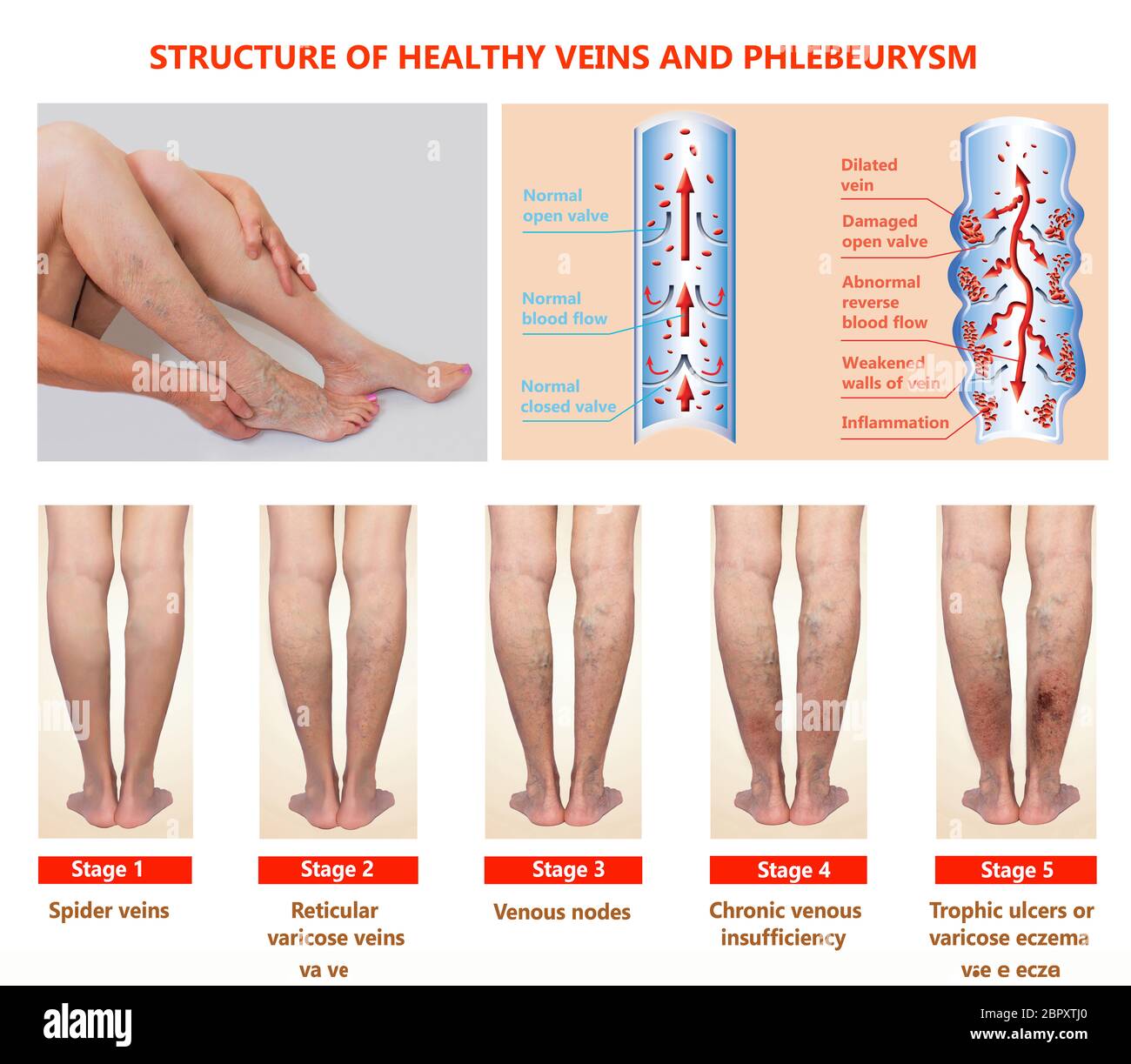 Thrombophlébite. Thrombose veineuse profonde. Varices. Phlebeurysm. Structure des veines normales et des veines malsaines Banque D'Images