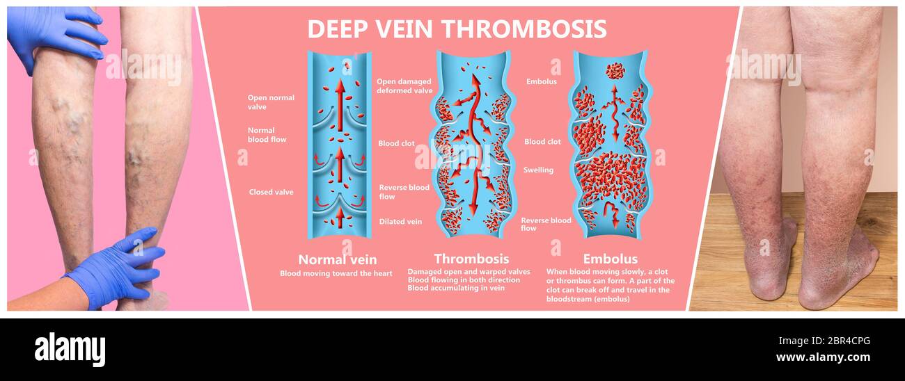 Thrombose veineuse profonde ou des caillots de sang. Embolie gazeuse. Structure de la normale et les varices veines femelle Banque D'Images