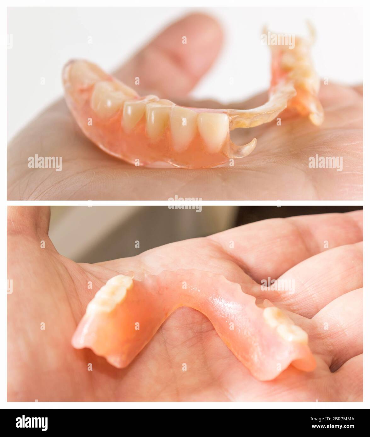 En nylon flexible prothèse sur la main des hommes. Dentiers amovibles souples, dépourvue de nylon, exempt de monomère hypoallergénique Banque D'Images
