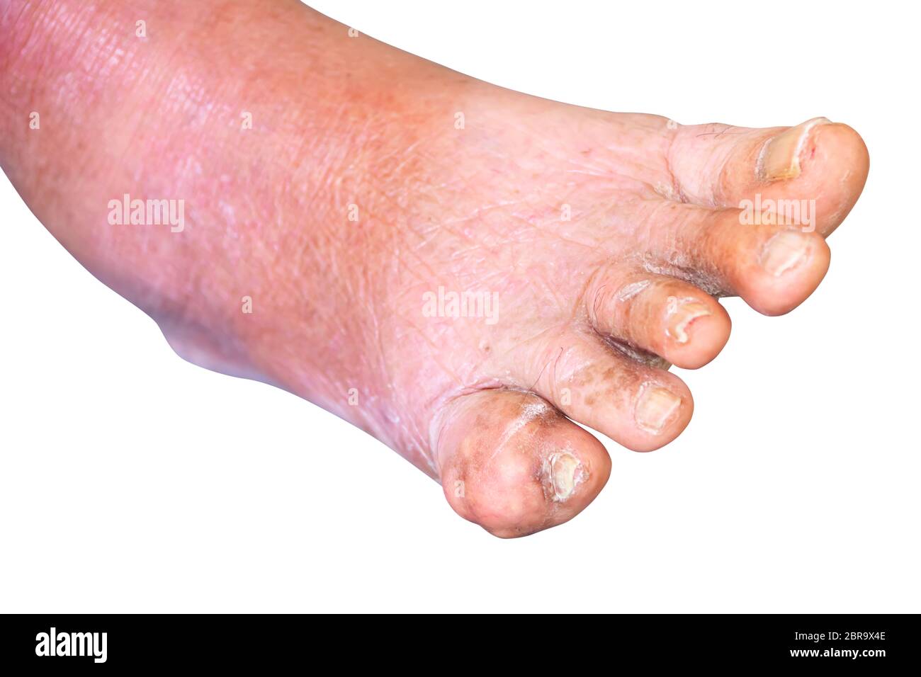 Pied de goutte petit doigt dans les personnes âgées gros plan sur fond blanc Banque D'Images