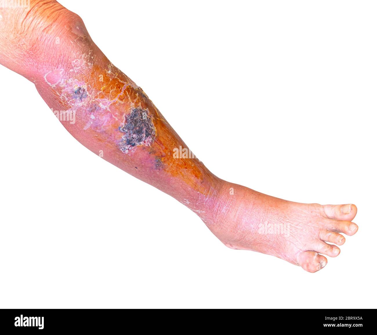Infection bactérienne d'erysipelas sous la peau de la jambe et du pied de  goutte personnes âgées sur fond blanc Photo Stock - Alamy