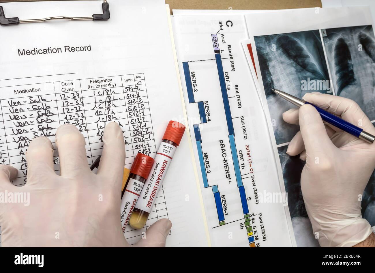 Le médecin détecte le diagnostic dans le poumon d'un enfant atteint par la maladie de Kawasaki avec plusieurs échantillons de sang dans un hôpital, image conceptuelle Banque D'Images