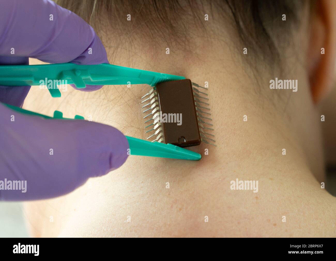 implantation de la puce sous la peau humaine. microchip est relié au corps femelle. Banque D'Images