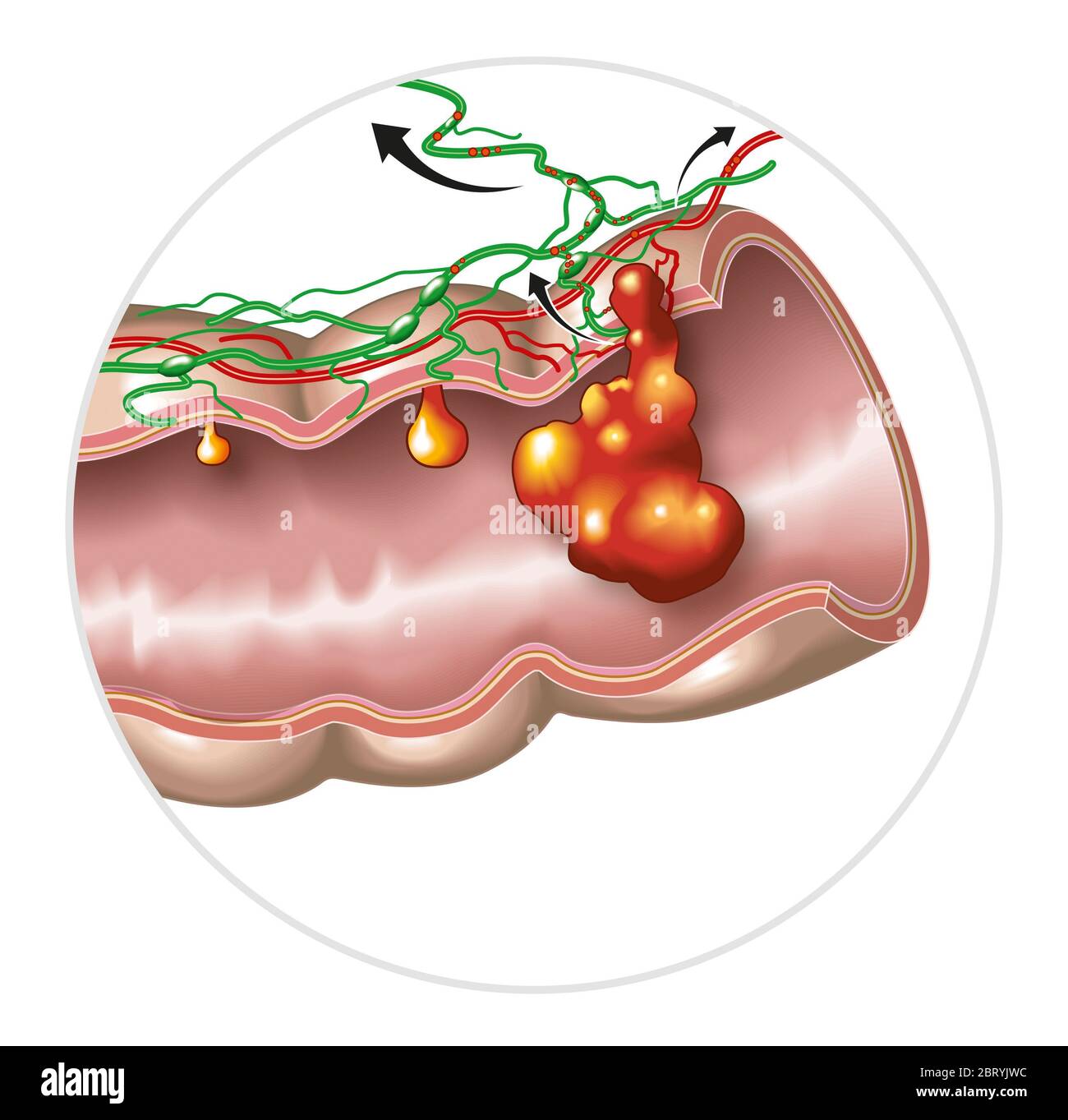 Illustration montrant une grande digestion avec polype intestinale, polype maligneux et cancer du côlon et se propageant dans les ganglions lymphatiques et les vaisseaux Banque D'Images