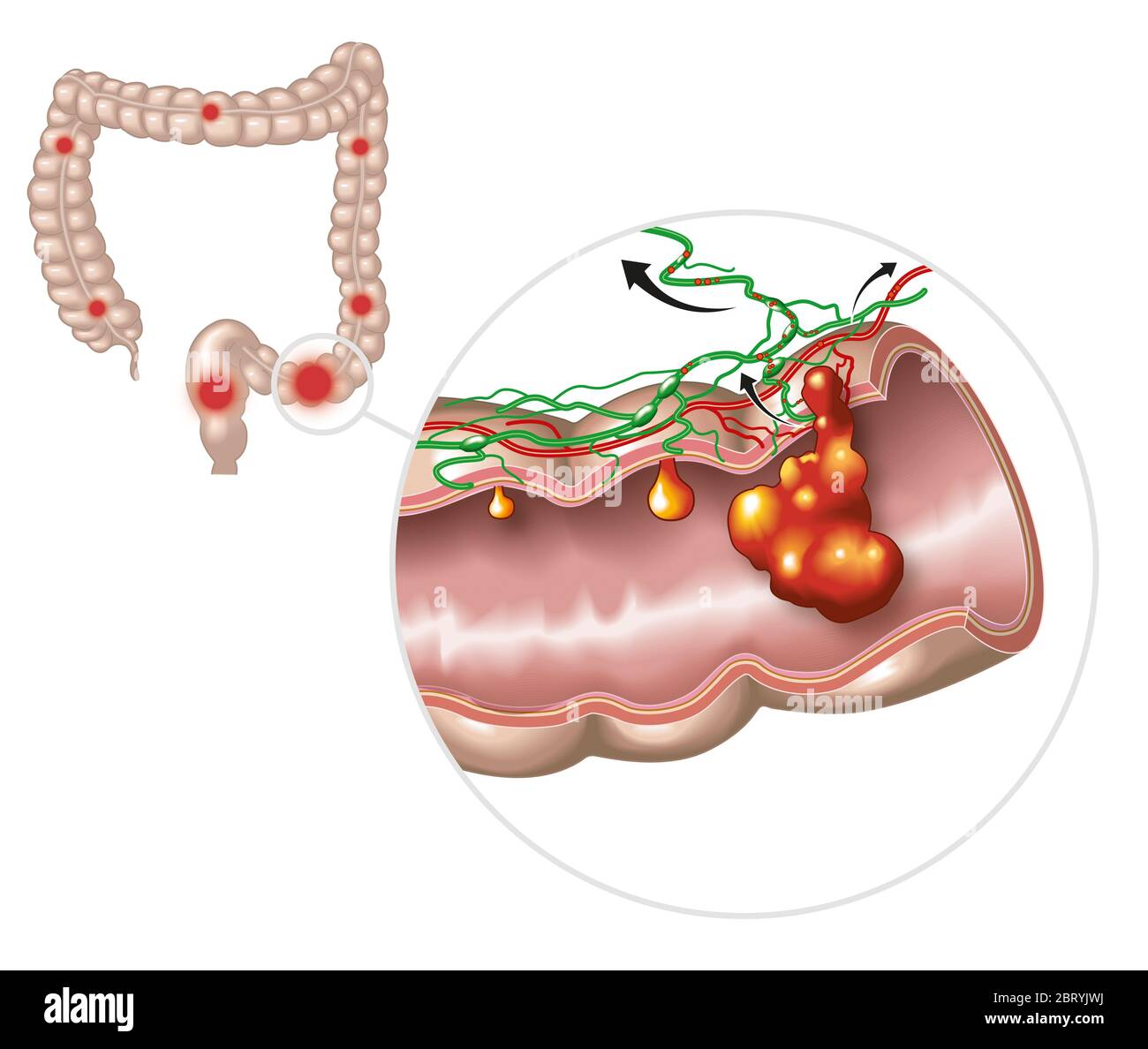 Illustration montrant une grande digestion avec polype intestinale, polype  maligneux et cancer du côlon et se propageant dans les ganglions  lymphatiques et les vaisseaux Photo Stock - Alamy