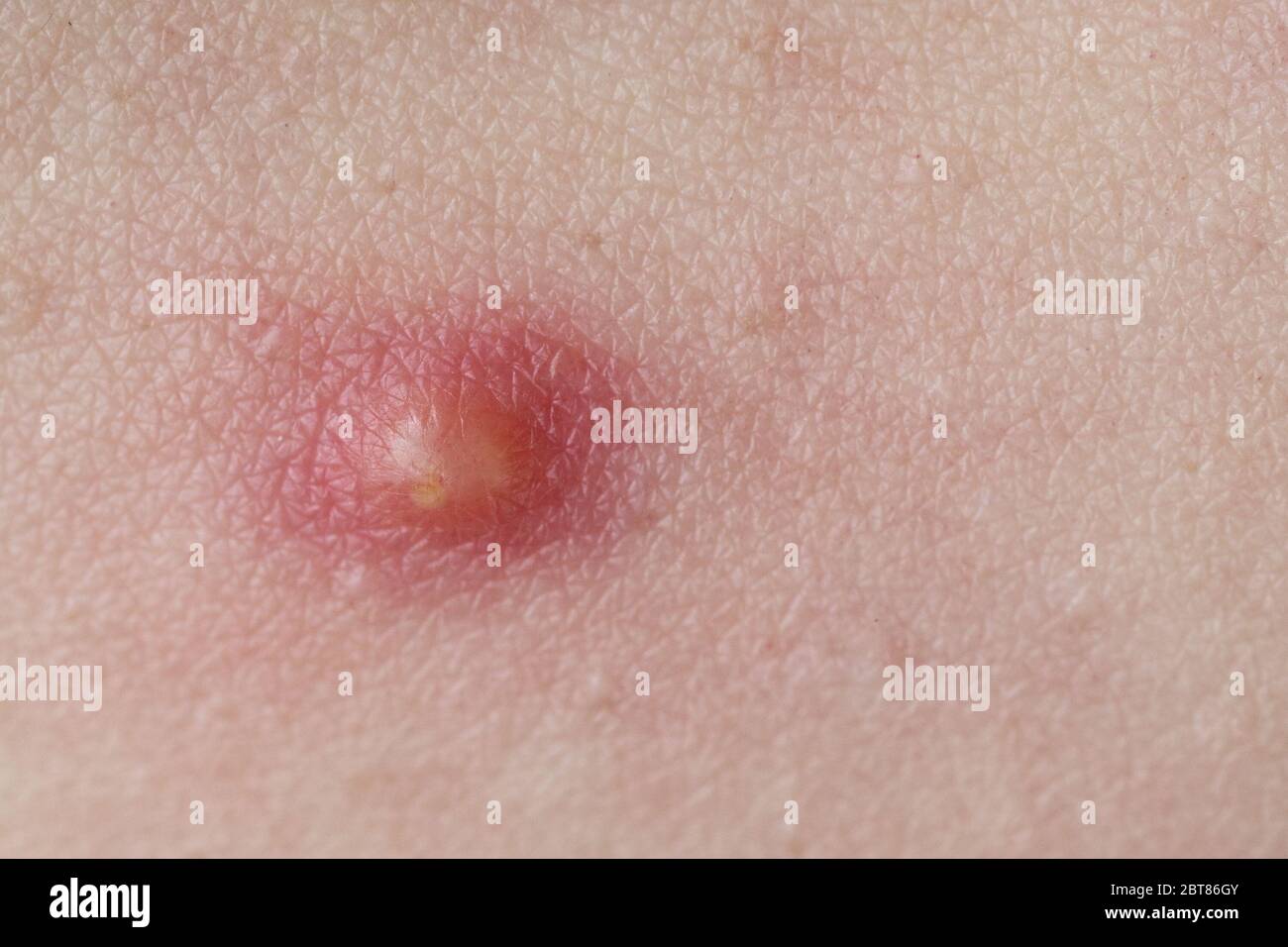 Bouton sur l'infection de peau bouton à pression Photo Stock - Alamy