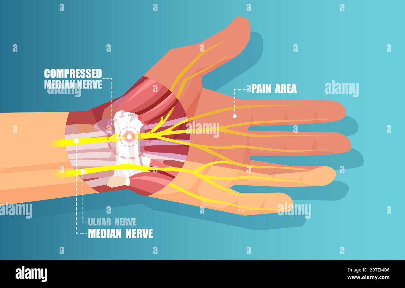 Illustration médicale vecteur d'un syndrome du canal carpien avec compression nerveuse médiane Illustration de Vecteur