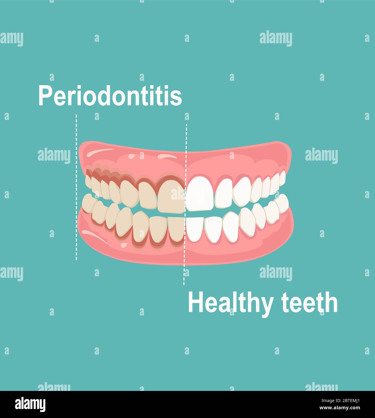 Vecteur des dents et des gencives humaines, en bonne santé et affectées par la parodontite Illustration de Vecteur