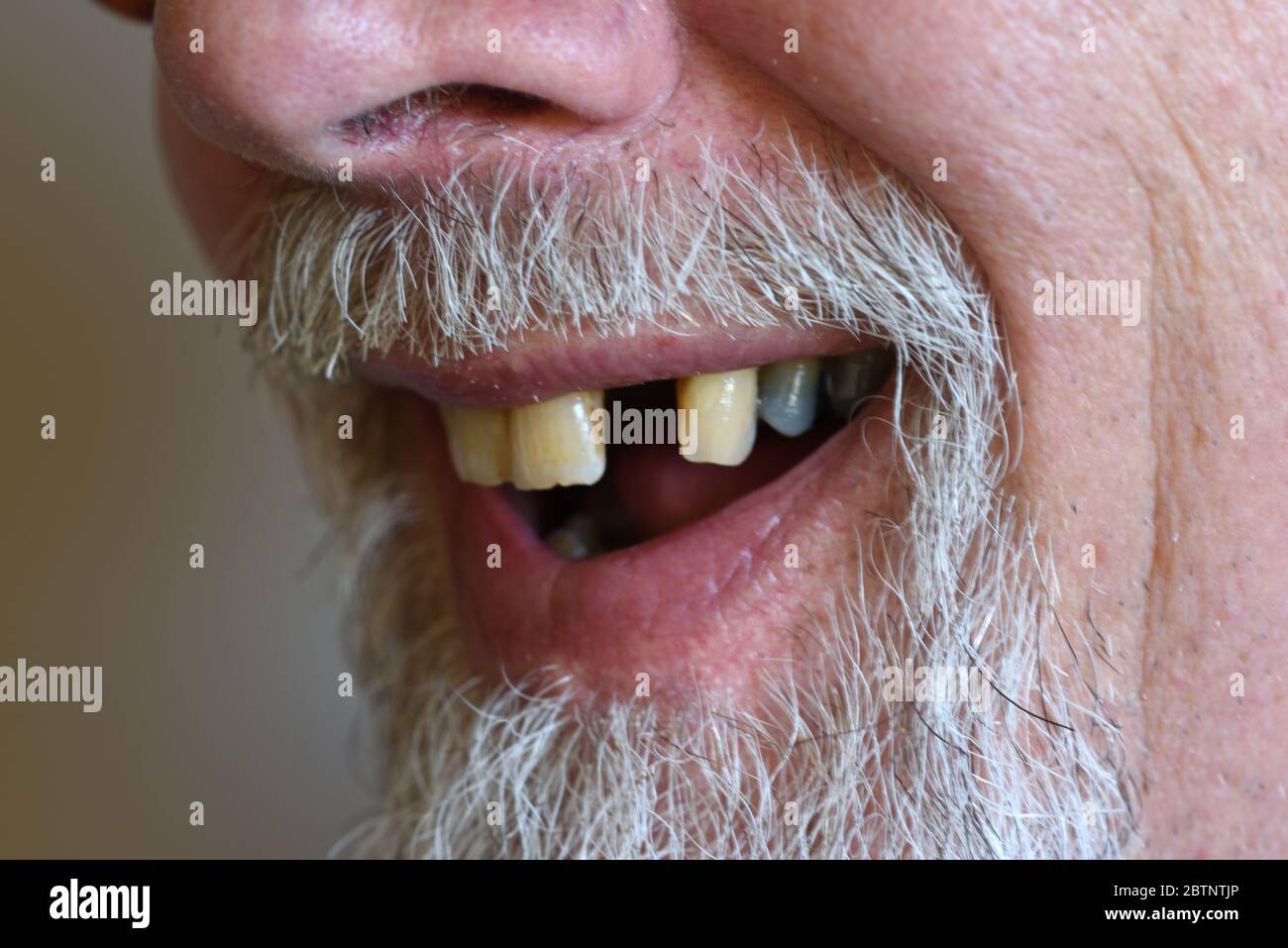 Vieux homme avec une dent manquante ou une dent d'Incisor latérale mandibulaire manquante Banque D'Images