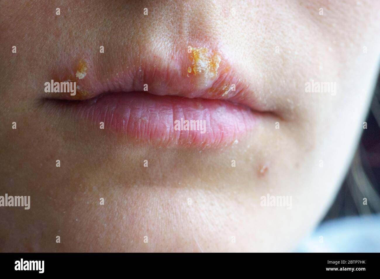 Herpes Sur La Levre Que Faire Traitement De L Herpes Labial YSSHXA herpes-sur-la-levre-que-faire-traitement-de-l-herpes-labial-ysshxa