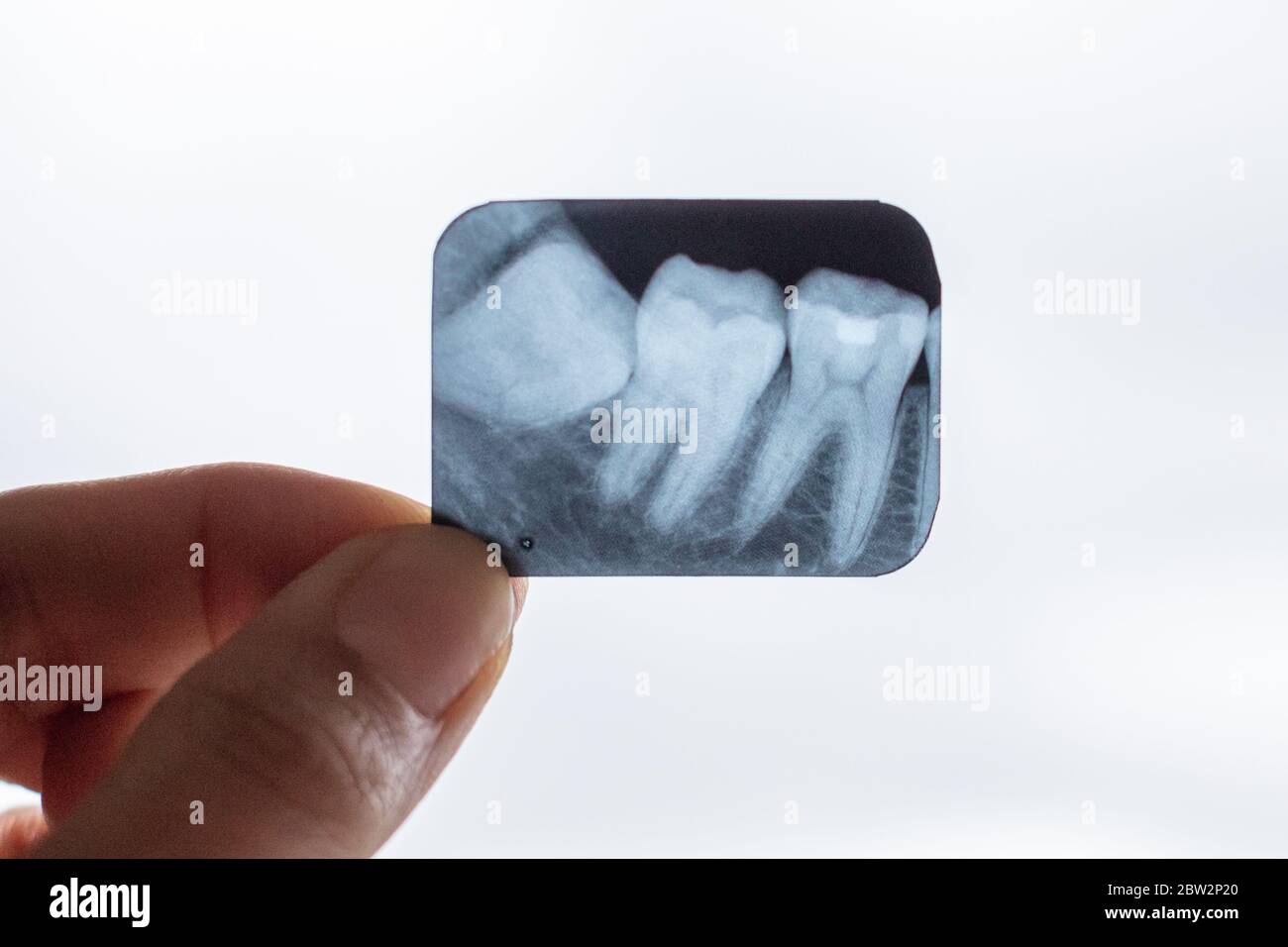 Rayons X des dents de sagesse dans les mains du dentiste Banque D'Images