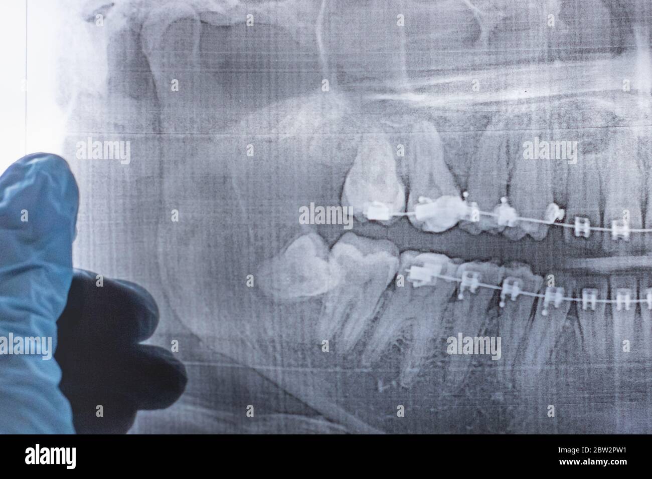 le chirurgien dentiste ganté tient une radiographie de la dent de sagesse inférieure retardée Banque D'Images