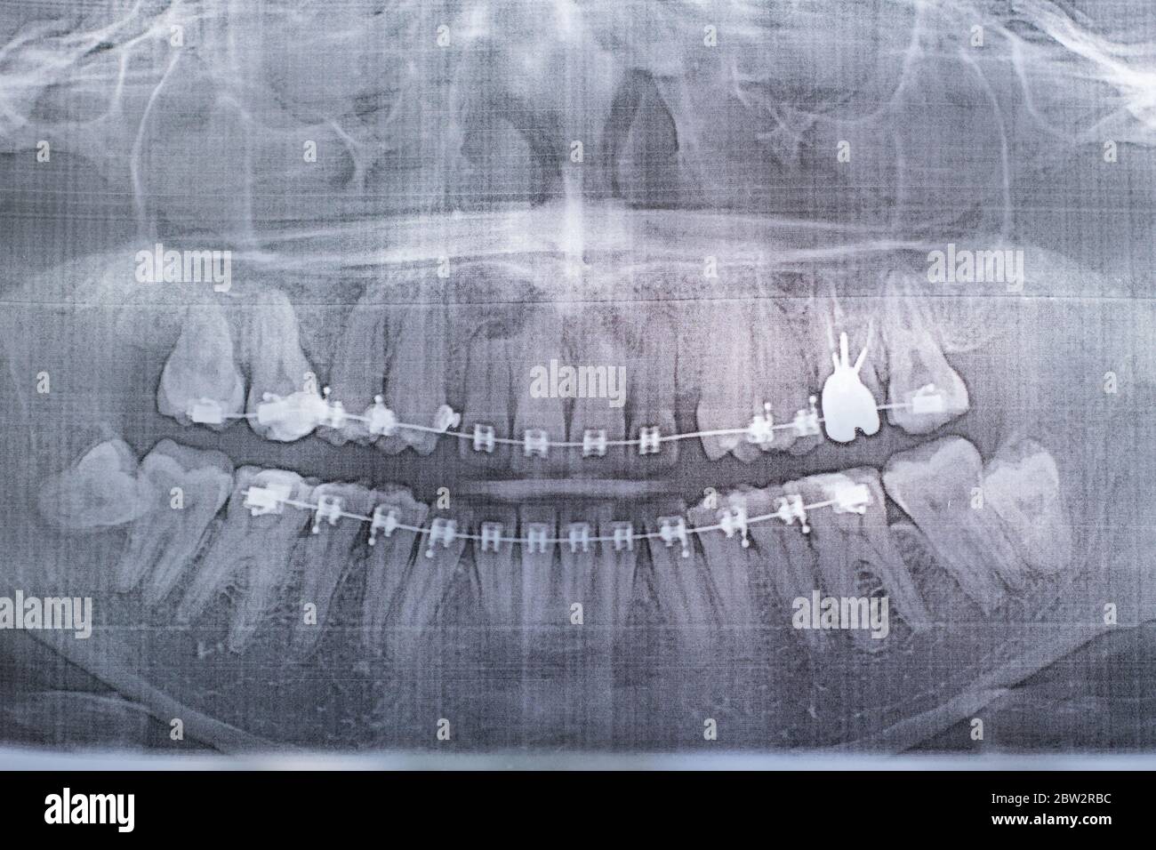 Photographie radiographique des dents humaines avec un système d'accolades. Dent de sagesse retardée Banque D'Images