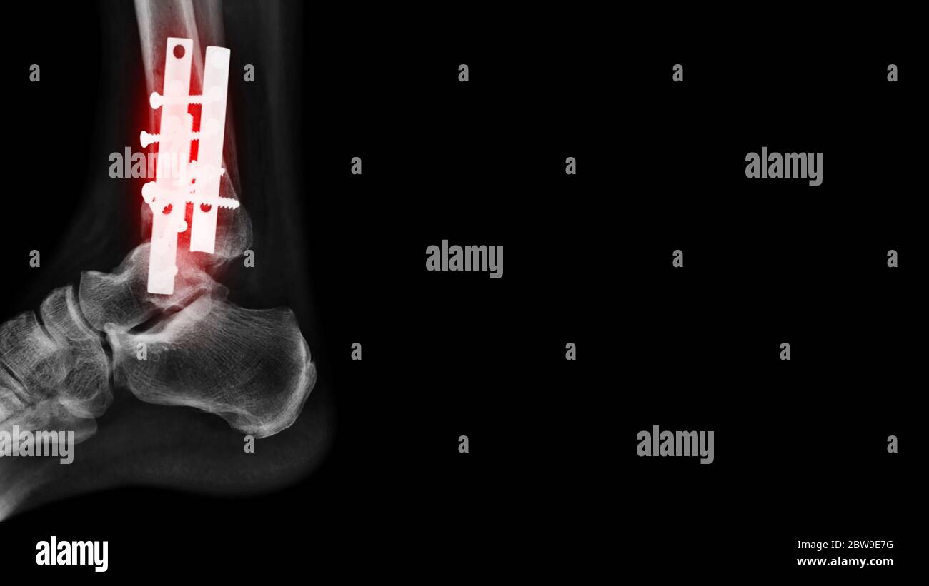 image radiographique de l'os du tibia avec fixation interne sur fond noir Banque D'Images