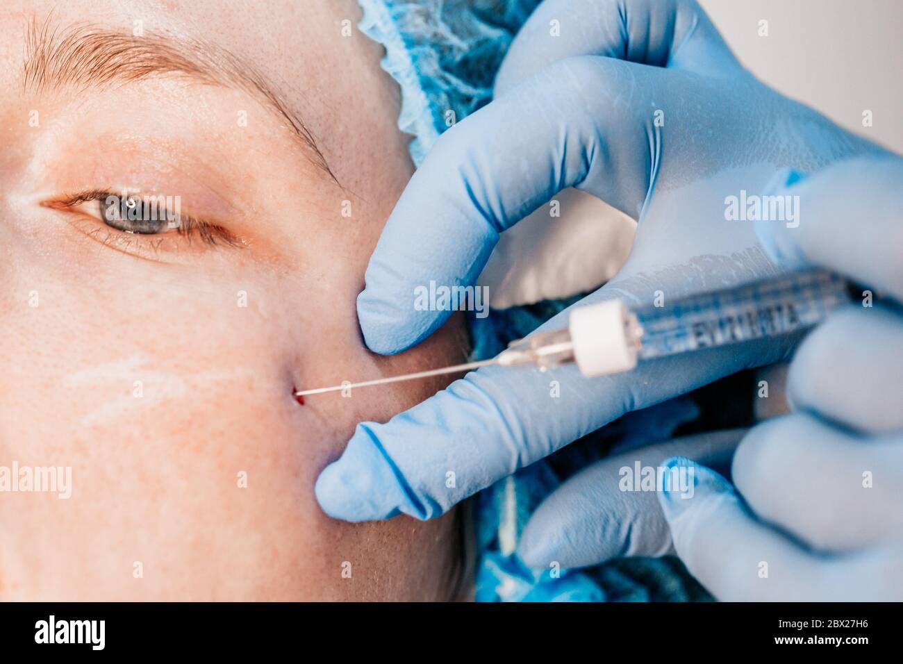 La correction de contour est une procédure permettant de remplir les rides et de restaurer le volume tissulaire - gros plan - le médecin injecte une seringue sous le Banque D'Images