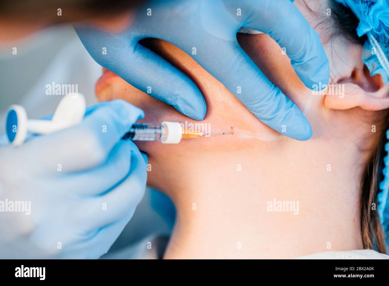 Mandibuloplastie non chirurgicale - gros plan - le médecin injecte une seringue sous la peau d'acide hyaluronique (matières de remplissage) Banque D'Images