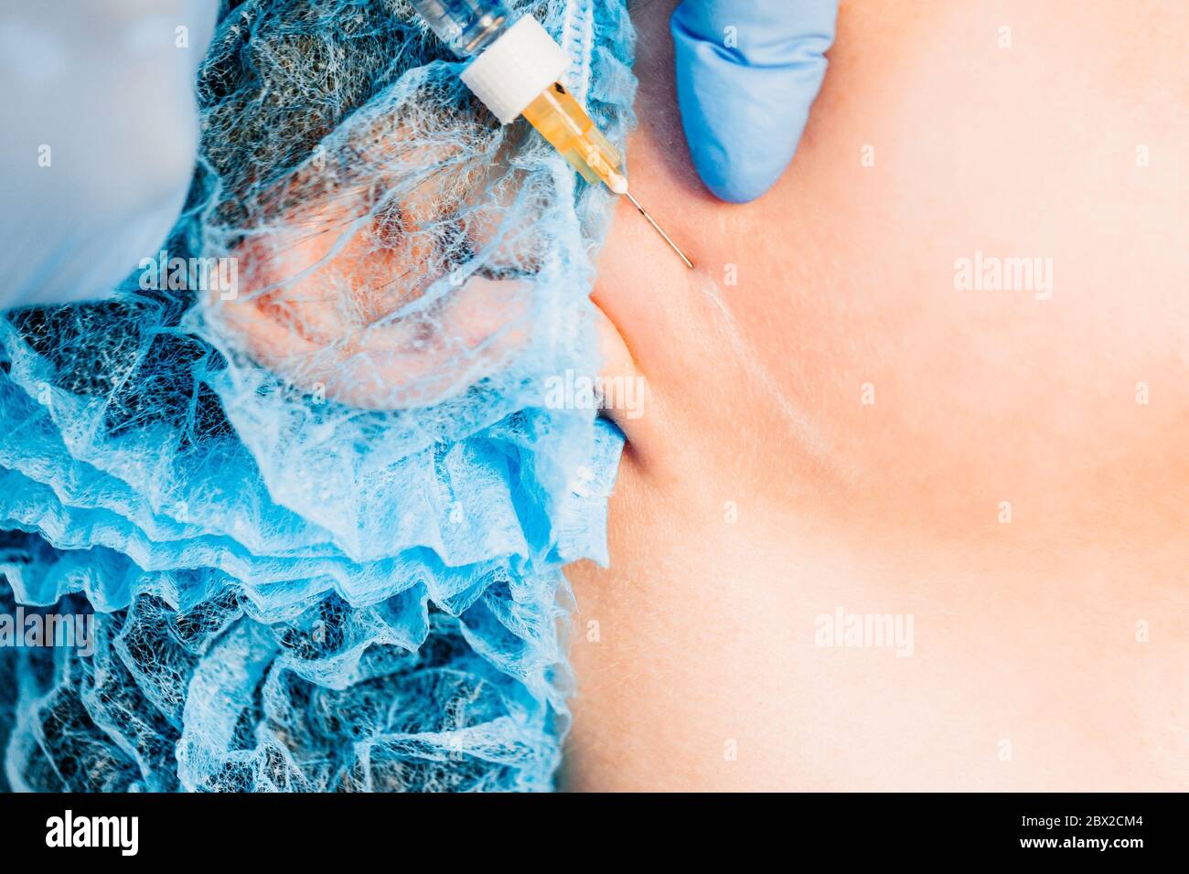 La correction de contour est une procédure permettant de remplir les rides et de restaurer le volume tissulaire - gros plan - le médecin injecte une seringue sous le Banque D'Images